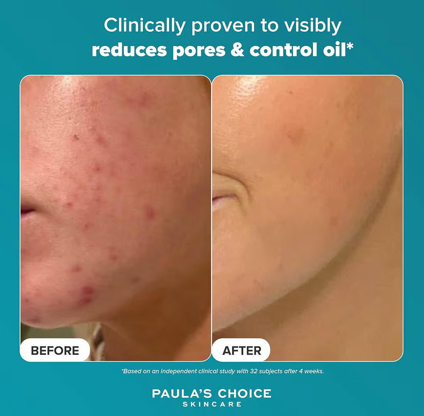 Paula's Choice SKIN PERFECTING 2% BHA Liquid Exfoliant - Face Exfoliating Peel Fights Blackheads & Enlarged Pores - for a Healthy Glow - with Salicylic Acid - Combination & Oily Skin - 30 ml